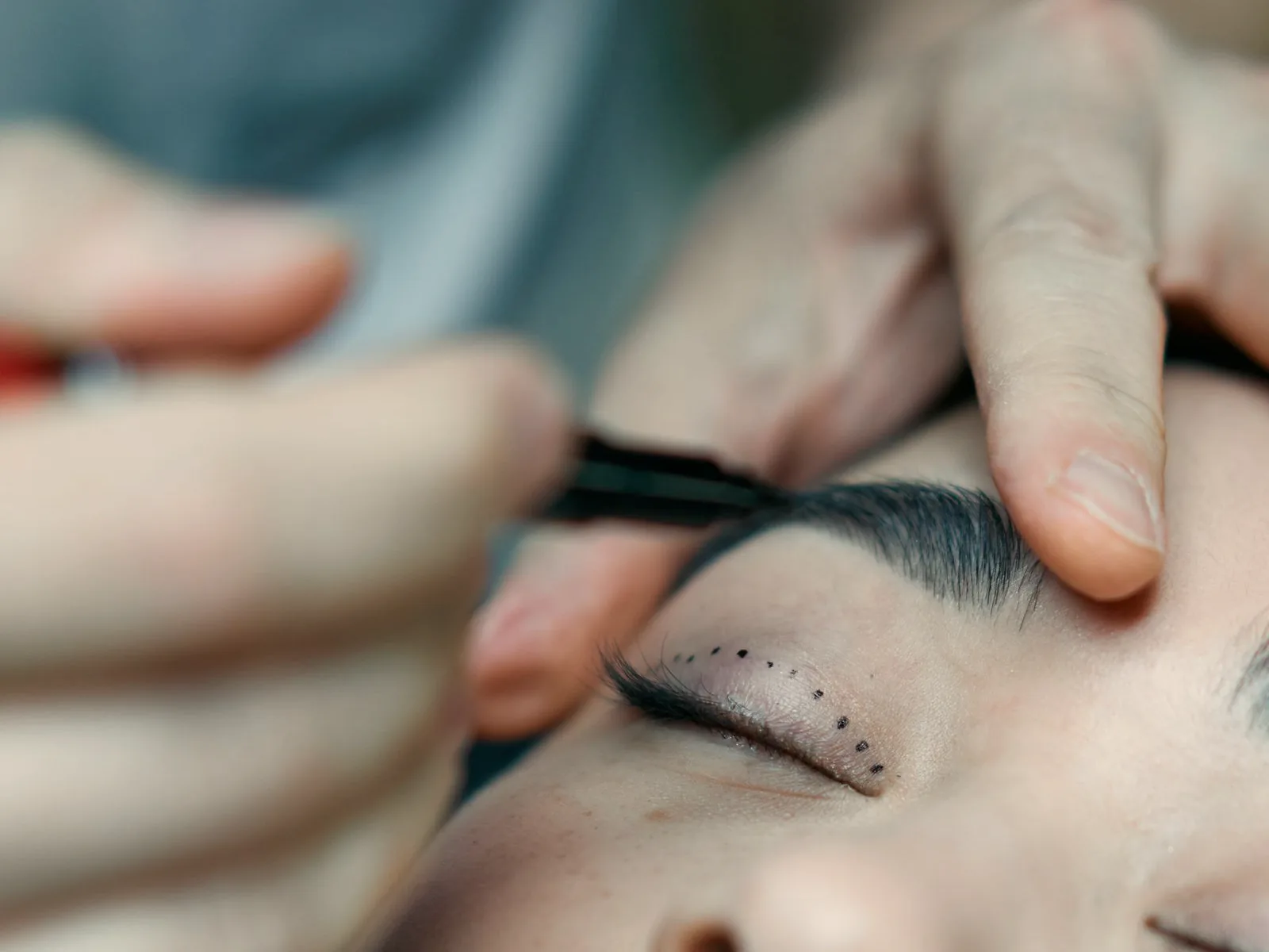 Marcação pré-operatória de pálpebra — planejamento de blefaroplastia